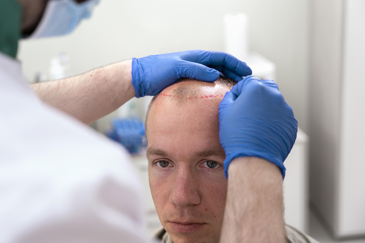 متى تظهر نتائج زراعة الشعر؟