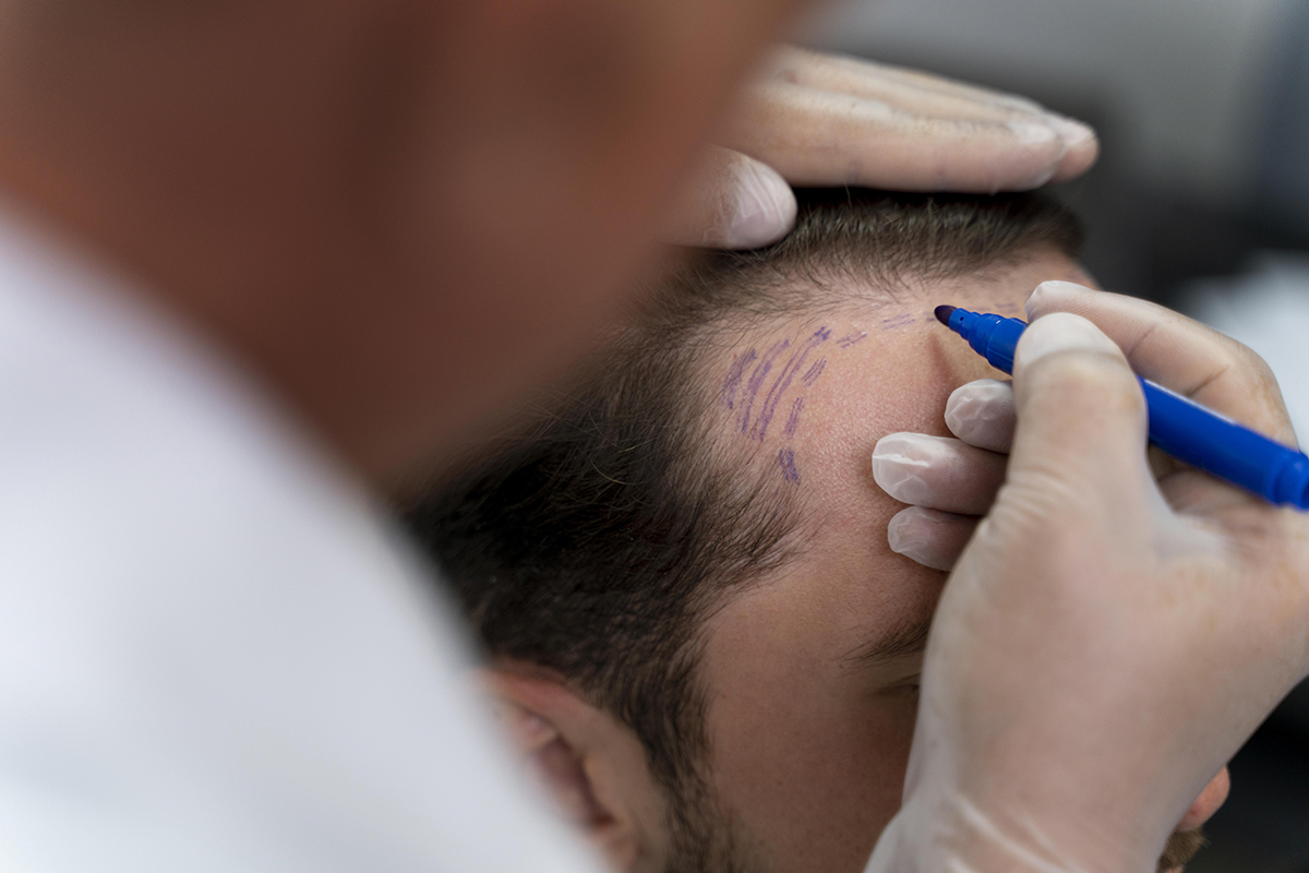 How Many Grafts Do I Need for a Hair Transplant?