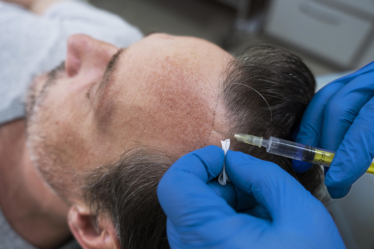 Causes of Hair Transplant Failure and How to Avoid Them