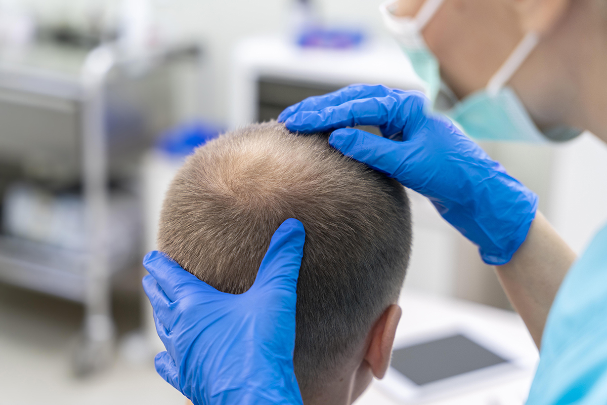 Is Transplanted Hair Permanent?