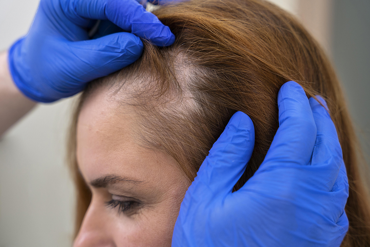 Hair Transplantation for Women: Is It a Suitable Option?